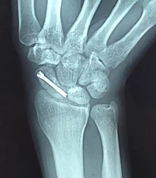 腕舟骨骨折
