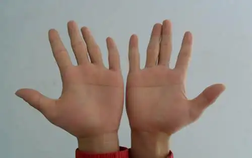 唐氏综合症患儿的体格发育一般落3体格发育落后唐氏综合症又称先天