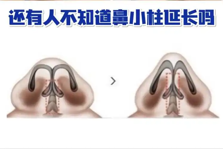 武汉美基元鼻小柱延长如何拯救鼻孔外露7171