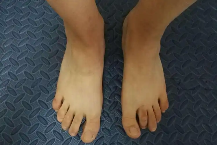 第二个脚趾弯曲多是锤状趾畸形导致,临床表现为第二脚趾的外形像锤子