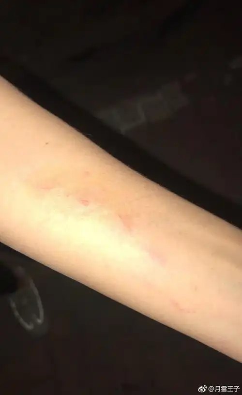 抓伤的左手臂