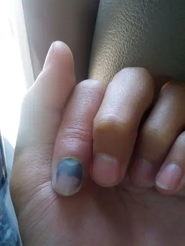 手指甲里面出血了怎么办好疼啊,是别人跑的时候我有话和他说就拽住了