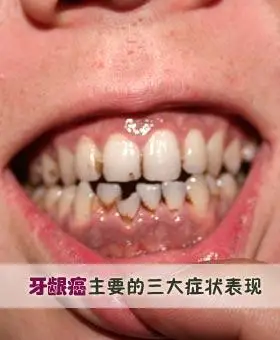 牙龈癌治疗方法_病因_症状_检查_饮食_专家在线咨询_求医网专题频道