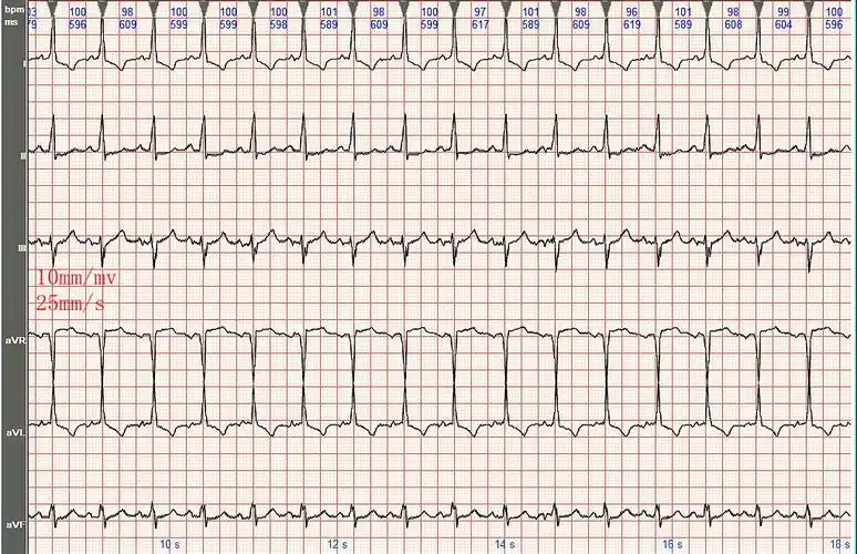 心电图病例分析:左心室肥大(2)