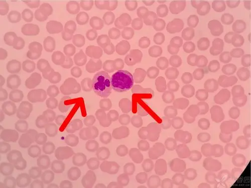 大家可能会怀疑血小板那么多为何你油镜下寥寥无几?