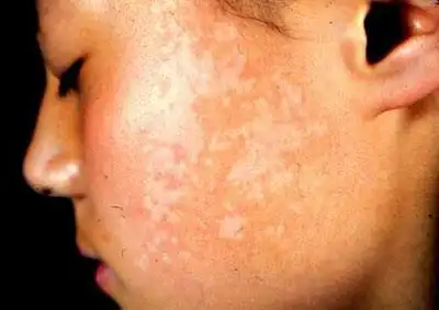 有可能是汗斑是图片上这样的吗?