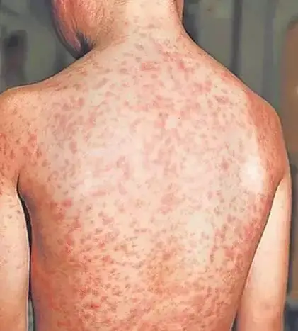 麻疹病毒通过麻疹病人的口水,痰,鼻涕等呼吸道分泌物飞沫传播,麻疹