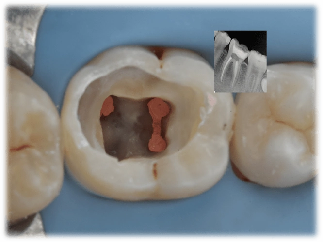 全国决赛12强病例展示 王林强 二类洞直接修复一例:右下五树脂充填