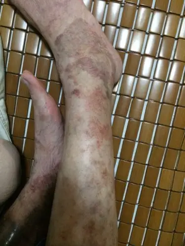 问:老年人脚静脉曲张到这种程度,年龄61岁,性别女,是该手术治疗还是