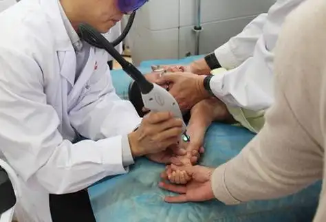 二,激光治疗的过程及方法