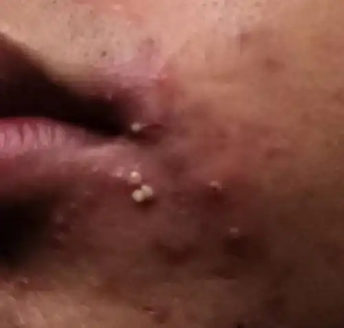 嘴角老是长这白色东西,每次挤出明天又有,反反复复的好不了,这到底是