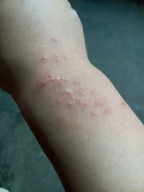 昨天早起出现的时候像荨麻疹,下午就变成小水泡了.痒的厉害.