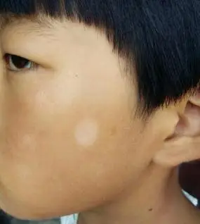 白色糠疹与白癜风有什么不同白色糠疹与白癜风有什么区别