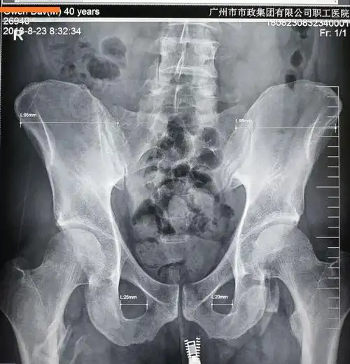 其它 先测量角度,再纠正骨盆旋移 写美篇         x线片:双侧髂骨的