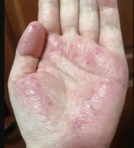 湿疹手还有救吗,整个手掌心都会有,奇痒无比!有图慎入!