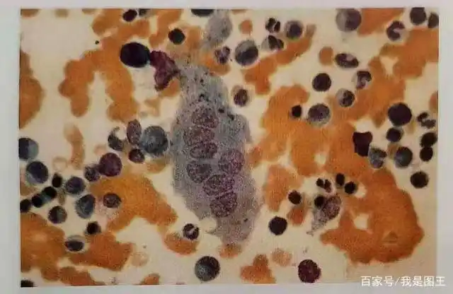 破骨细胞是多核细胞