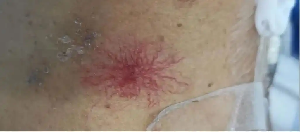 35岁男子皮肤出现蜘蛛痣发现时已肝癌晚期