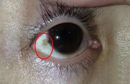 白眼球上有黄斑眼睛黄斑变性原因分析注意事项