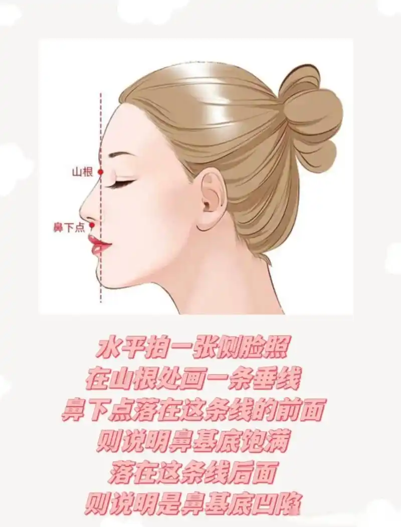 鼻基底凹陷自测93 ◎水平拍一张侧脸照,在山根处画一条垂线,看鼻下