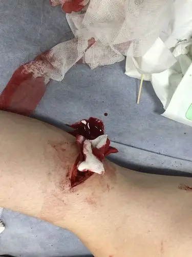 三处,其中一个九公分,皮开肉绽.我该报警让他坐牢吗