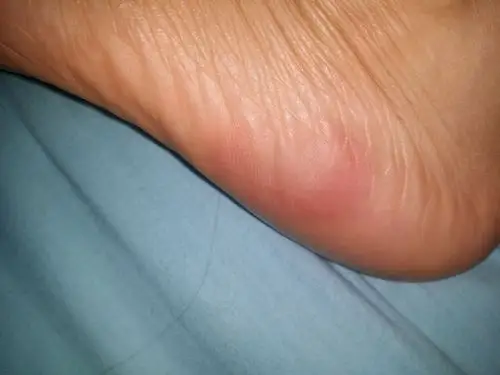 本人4月28号左右开始,脚底红肿,疼.