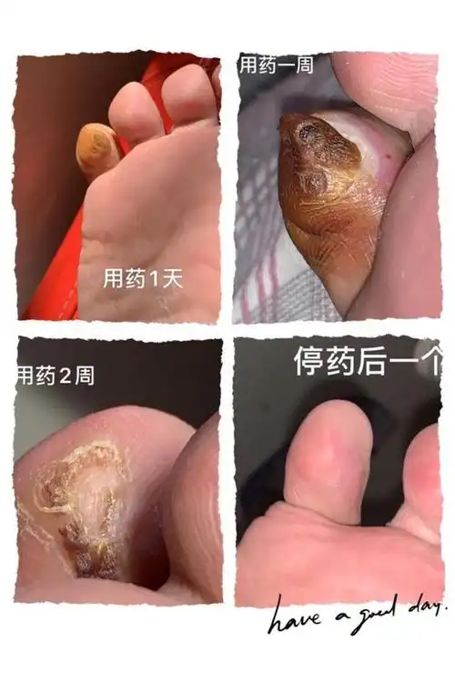 治疗跖疣小妙招
