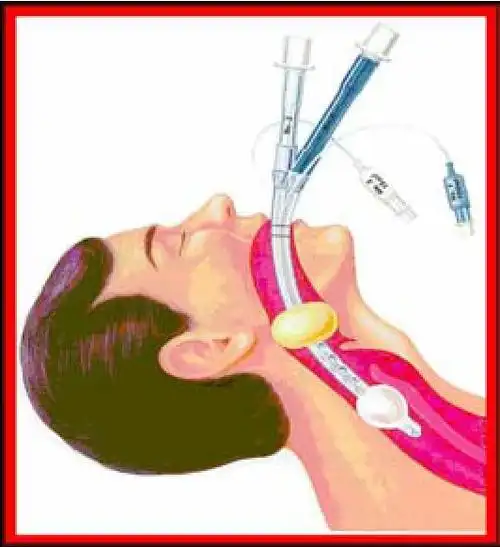 图9-44 食管-气道联合管(combitube)4.