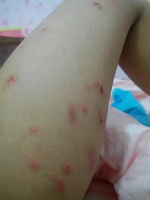 虫咬性皮炎敏症状图片_有来医生