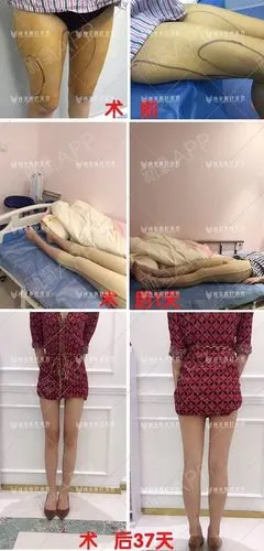 【深圳颜美吸脂】吸脂会疼吗?有效果吗?会反弹吗?