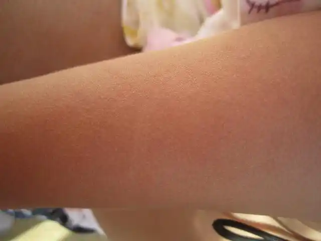 宝宝胳膊上起了好多像小米粒一样的疙瘩 一撮一撮的