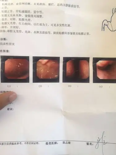 胃镜检查慢性浅表性胃炎 可图片怎么看起来表面突肿