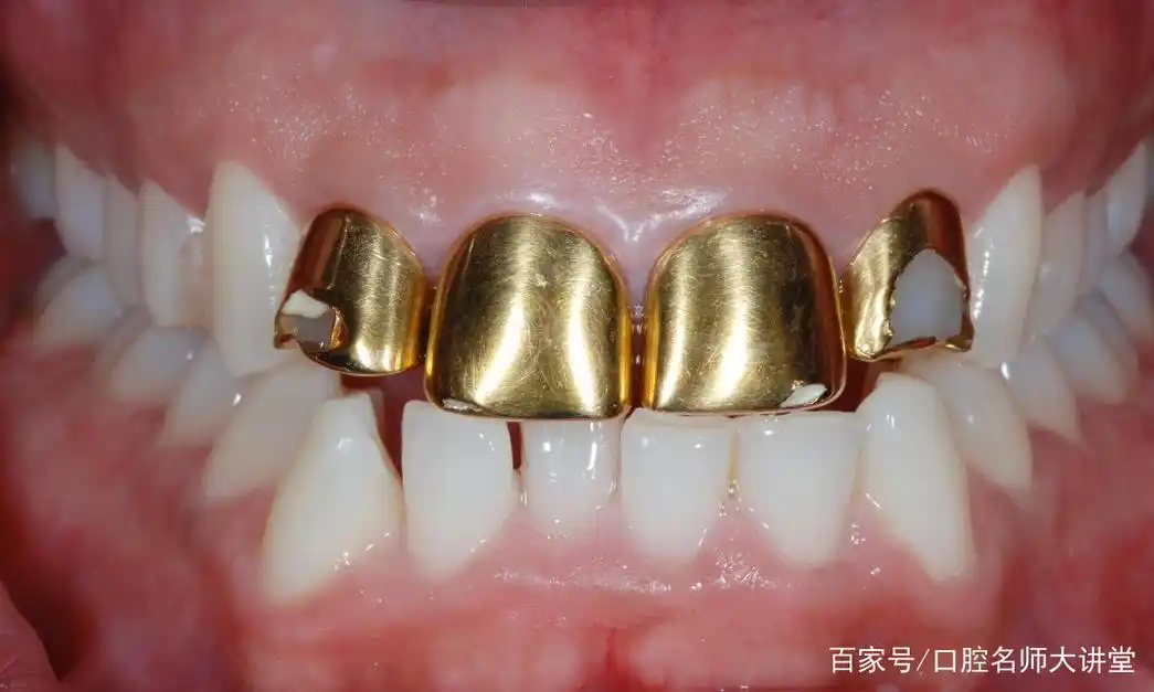 「牙科医生继续教育课程16」解读部分冠制作工艺流程