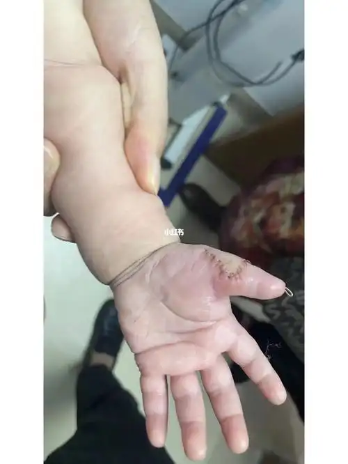 多指手术后第三次换药