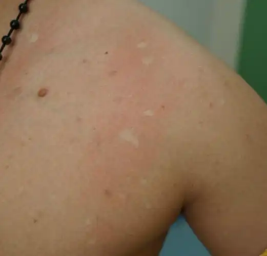 贫血痣白斑摩擦后