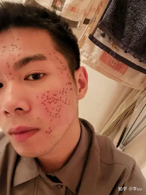 点阵激光第一次