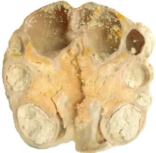 intestinal tuberculosis急性粟粒性肺结核 acute miliary pt结核