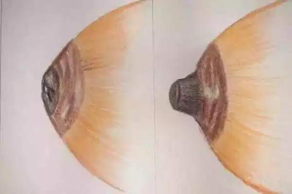 乳头凹陷是乳腺癌的表现吗?