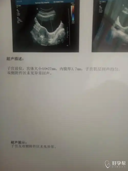 帮我看看这样子宫正常不