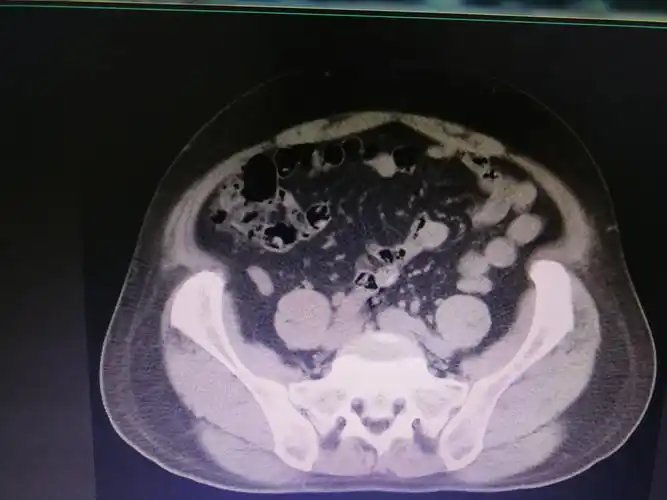 有种腹痛叫结肠憩室!