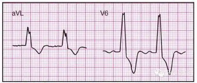 最全面的异常心电参考图建议收藏
