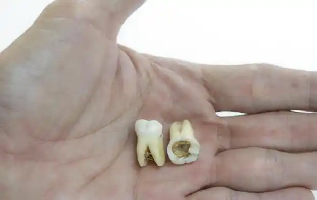 蛀牙(龋齿)是怎么形成的?牙痛时怎么快速止痛?