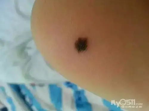 医生:孩子身上有痣别轻易去除!
