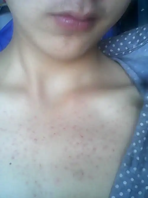 胸前长痘痘怎么回事啊?