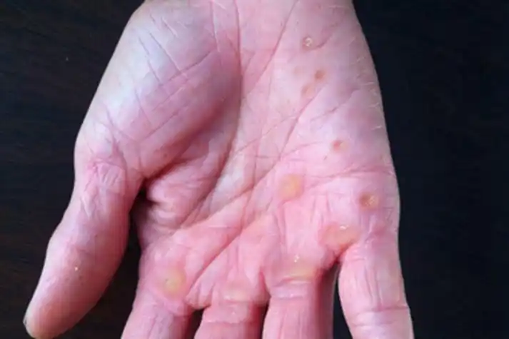 掌跖点状角化手掌症状图