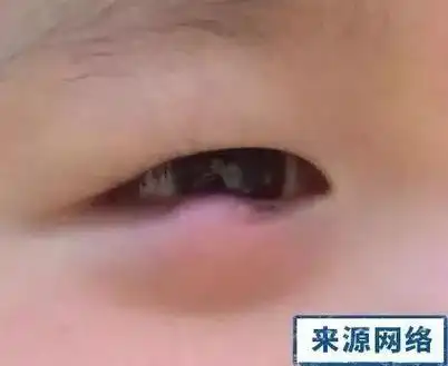 孩子眼睛肿痛急坏家长原来是长了这个