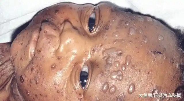 第一个得艾滋病的人, 到底对黑猩猩做了什么? 并将其危害其他人!