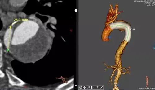 支架系统治疗胸主动脉夹层 ——延安大学附属医院心脏血管医学中心