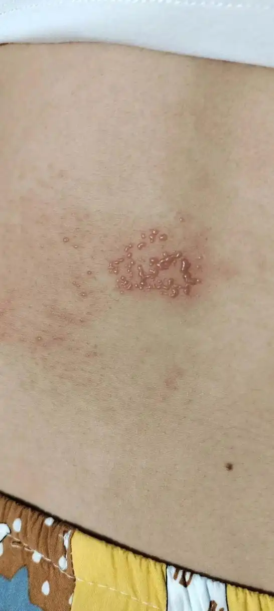 带状疱疹前期症状 症状 8月8-11号左侧腰痛(带状疱疹一般单侧腰部),误