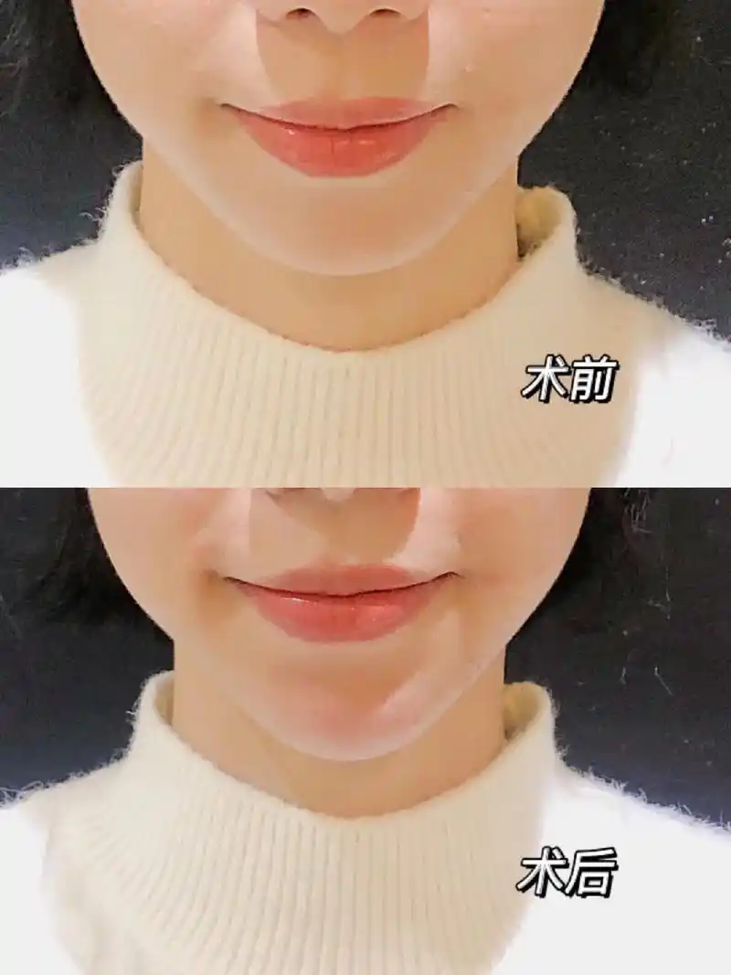 打之前完全没想到国产玻尿酸效果可以这么好,现在的下巴简直就是 - 抖