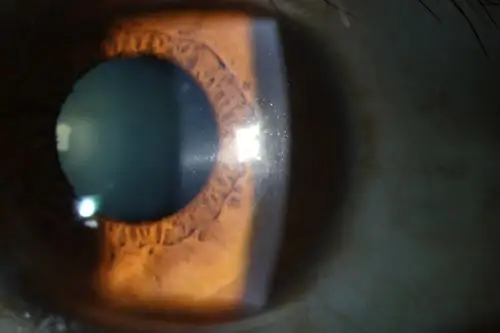 "废"透镜再利用 为角膜病患者带来希望